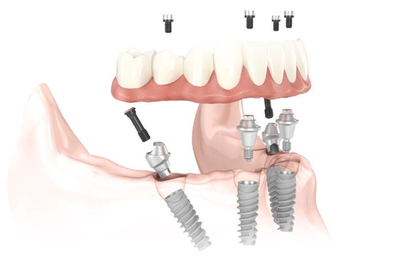 Implant