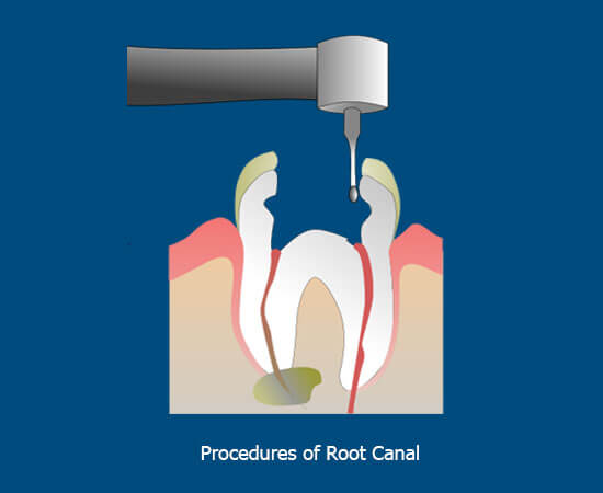 root canal process accessing the root