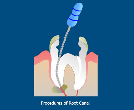 root canal process canal fillings