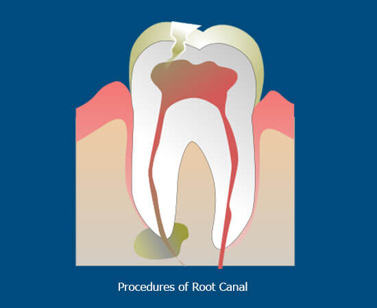 root canal process examining the infection