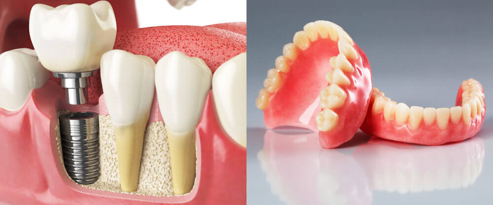 implant and dentures