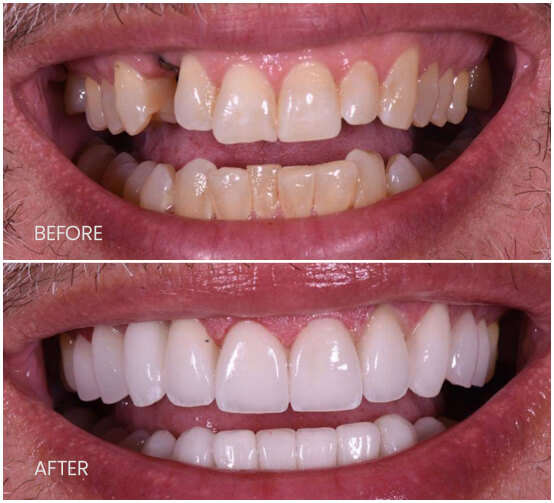 benefits of getting dental implants