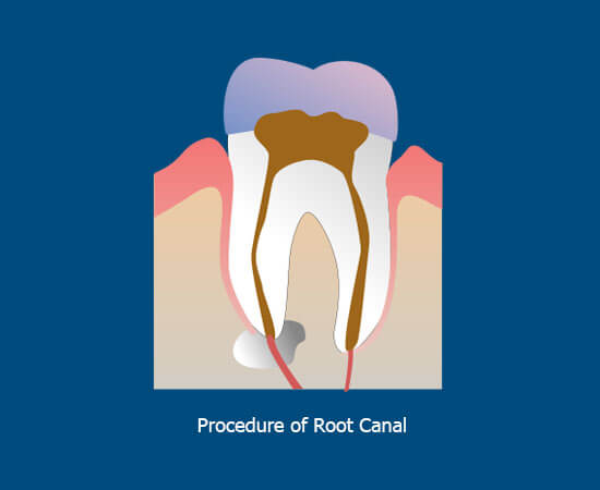 root canal process tooth rebuilding