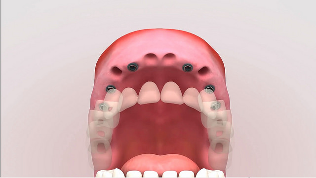 dental implants benefits