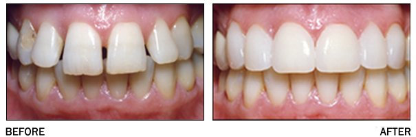 before and after dental veneers