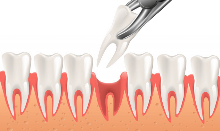 tooth extraction service