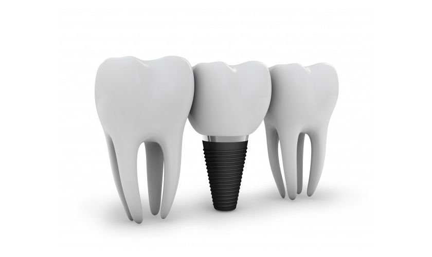Best dental implants dentist in Carthage NY