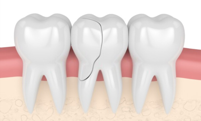 Cracked Tooth Treatment in Carthage
