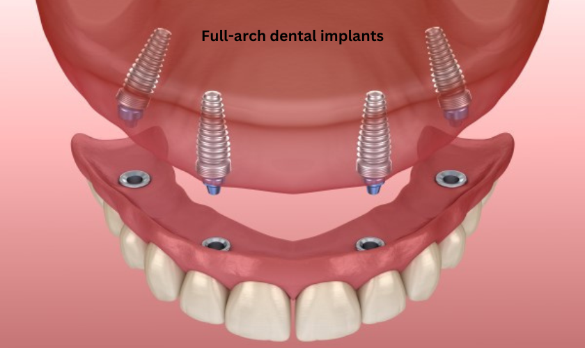 Full-arch dental implants