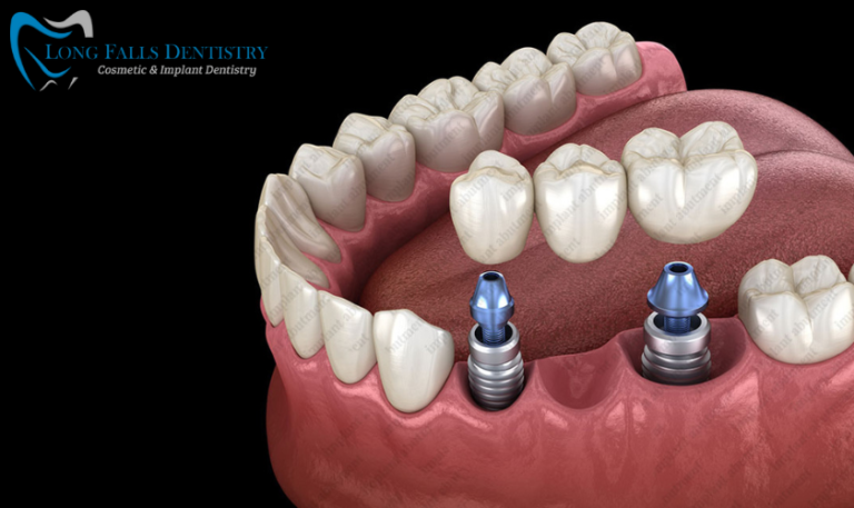 Everything You Need To Know About Abutment Teeth - Long Falls Dentistry