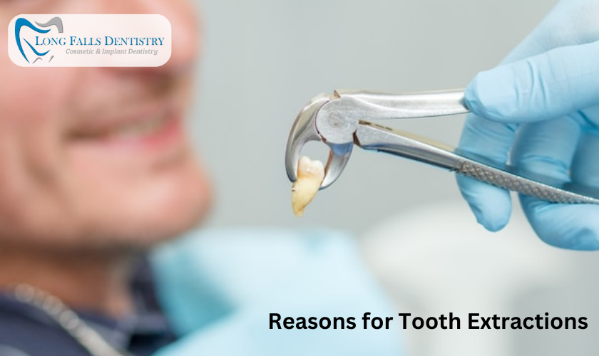 Reasons for Tooth Extractions