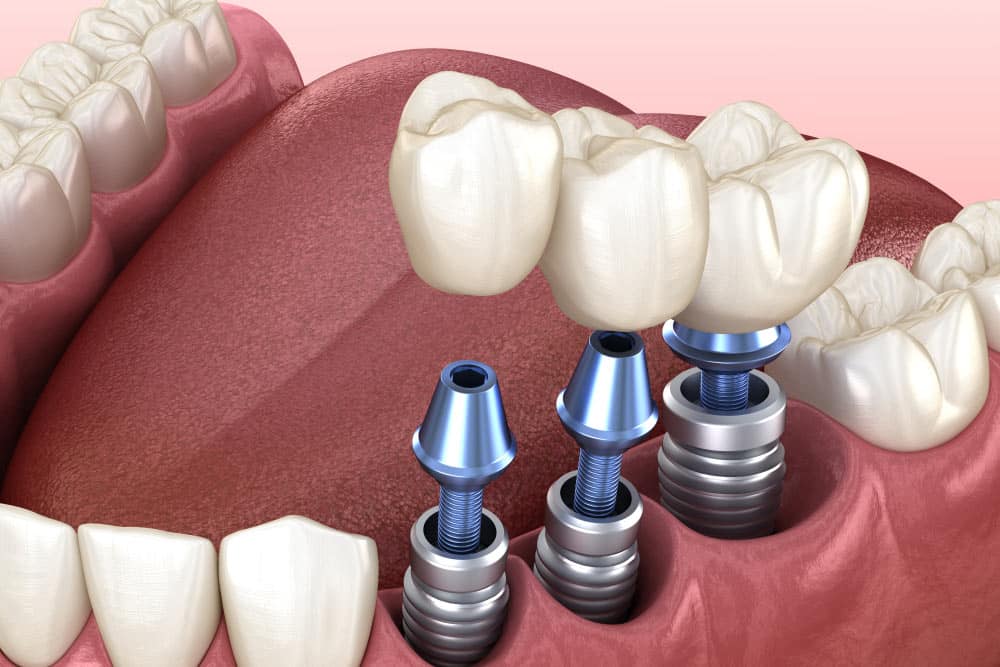 dental implants technology