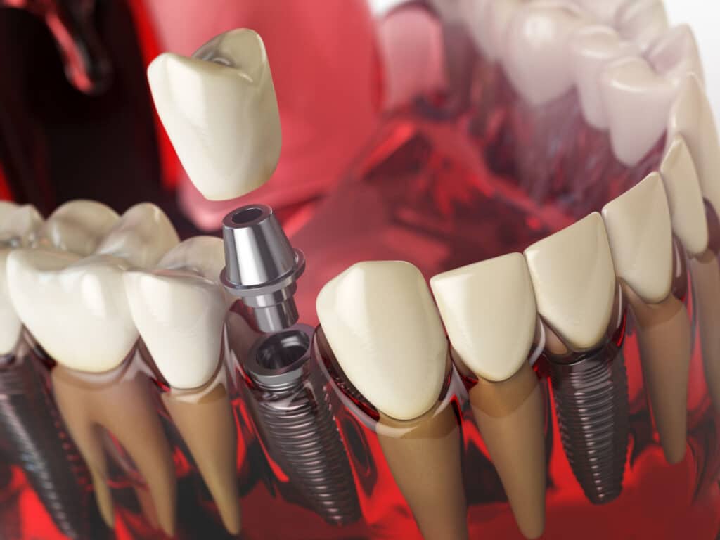 The Longevity Of Dental Implants