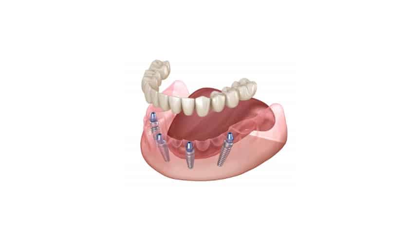 full arch implants-long falls dentistry