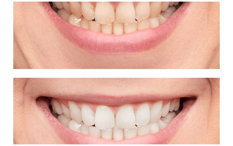 How To Maintain White Teeth: Tips And Tricks