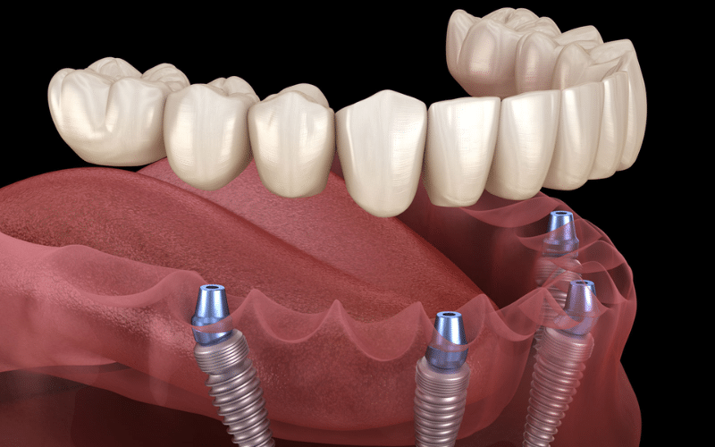 Steps To Determine Your Candidacy for Full Arch Implants 