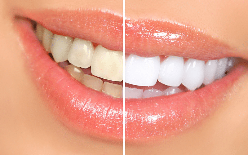 Zoom Whitening Treatment