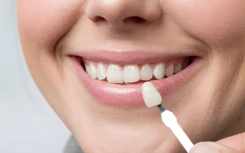 How To Choose The Right Shade For Your Porcelain Veneers