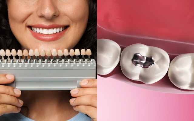 porcelain veneers vs tooth fillings