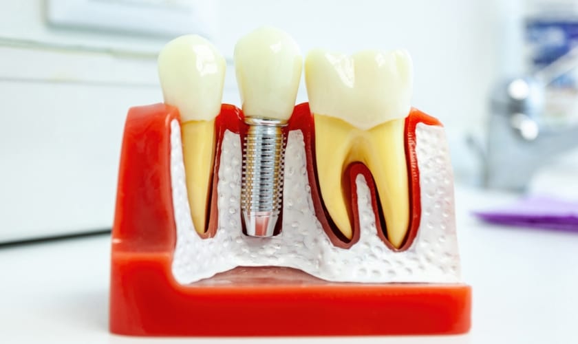 dental implants in Carthage