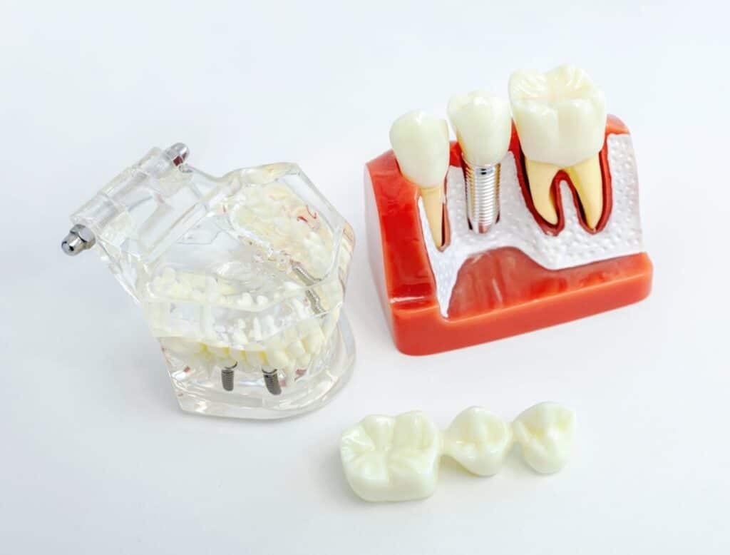 Dental Implants in Carthage